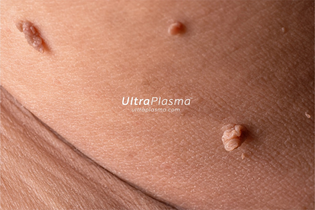 ultraplasma.com_wart_treatment_sigil_tedavisi_ultra_plasma_ultra_plazma_genital