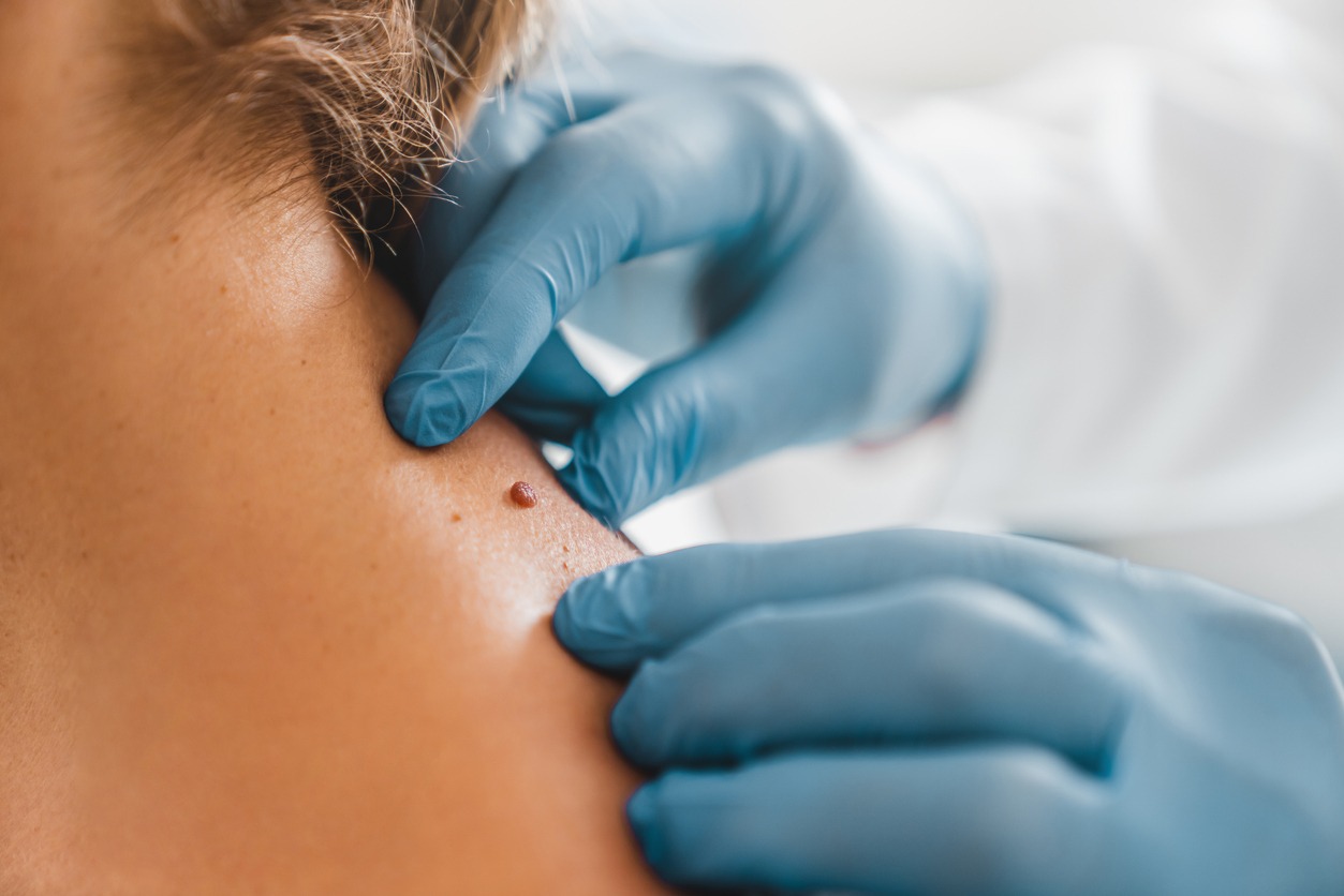 Papilloma removal