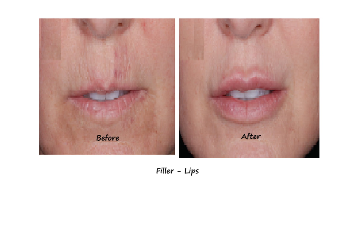 Before and after photos filler lips– more volume, fewer wrinkles around the mouth, natural shape