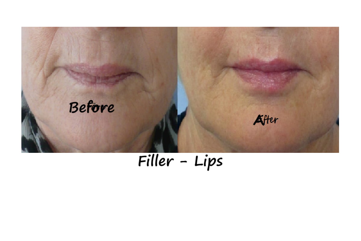 Before and after photos filler lips– more volume, fewer wrinkles around the mouth, natural shape.