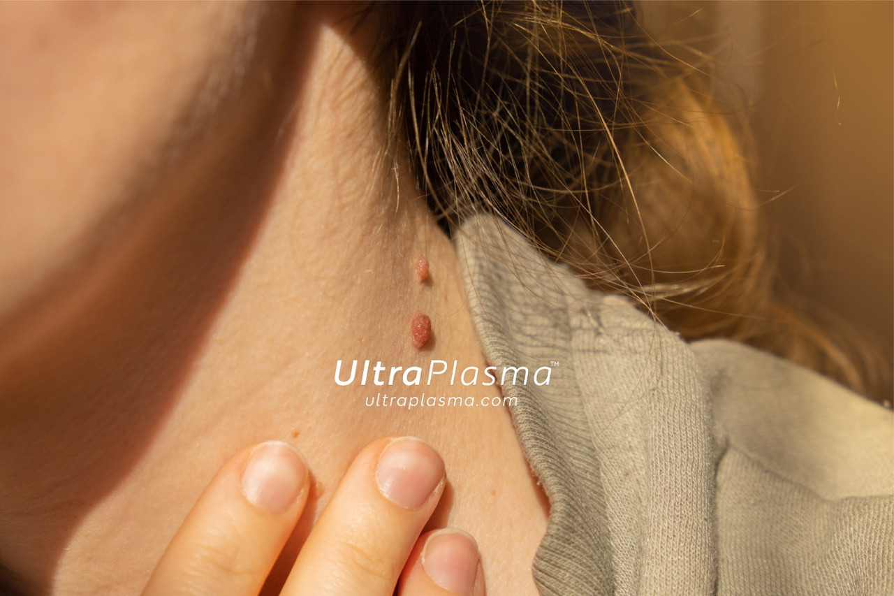 ultraplasma.com_skin_tag_removal_treatment_et_beni_temizleme_silme_tedavi_ultra_plasma_ultra_plazma