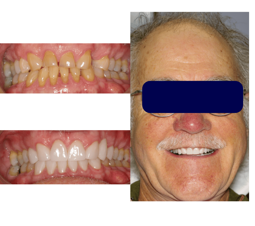 collage of man with dental restoration