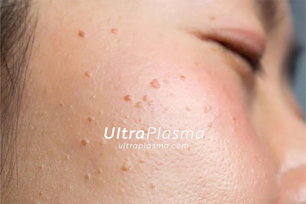 ultraplasma.com_wart_treatment_sigil_tedavisi_ultra_plasma_ultra_plazma_mouth_agiz