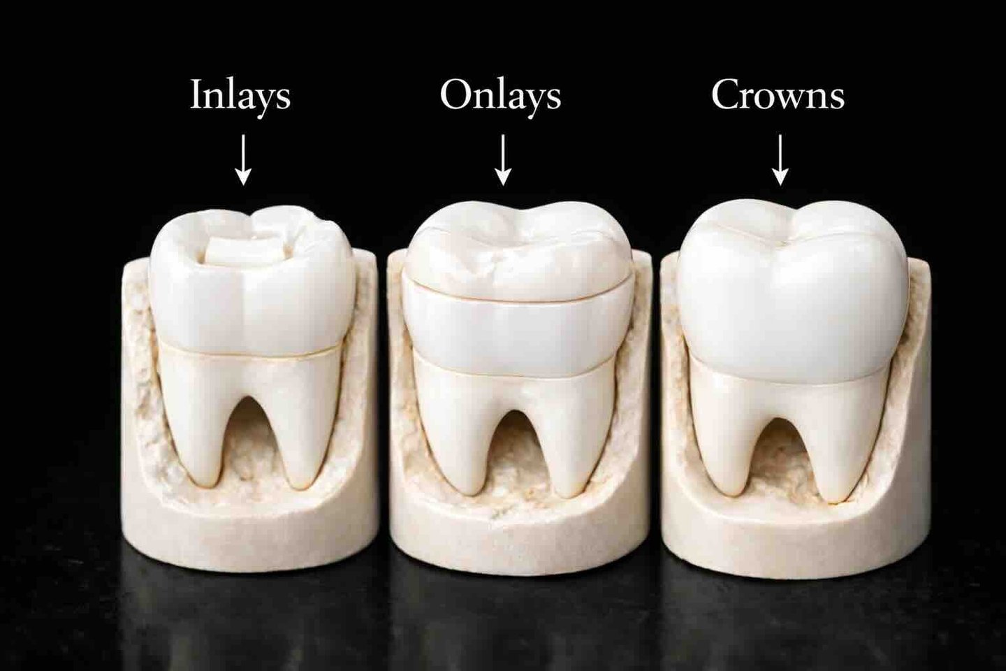 Inlays & Onlays treatment