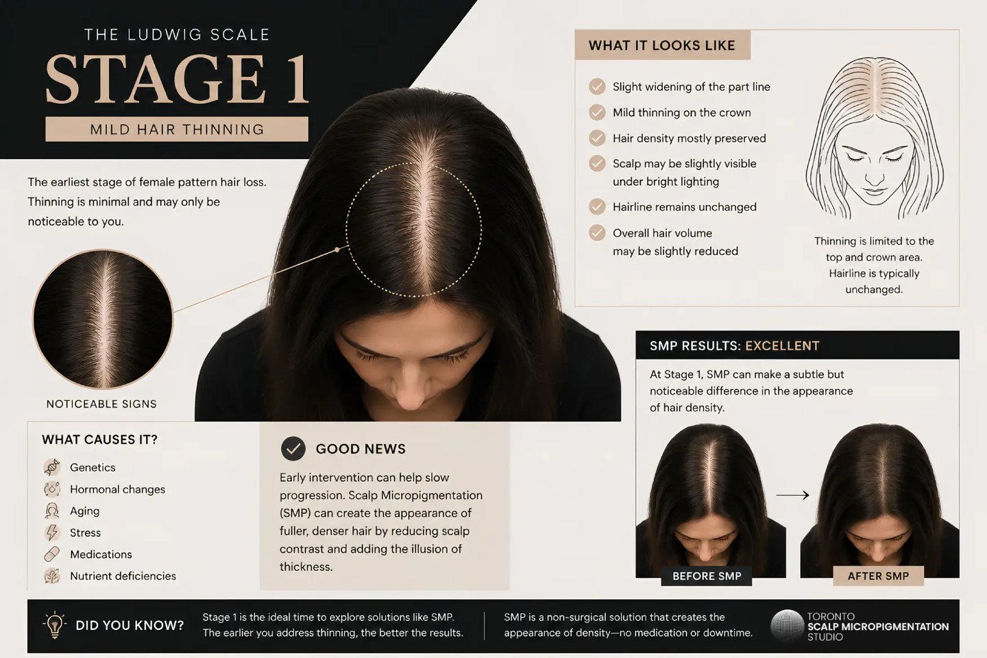 An educational guide on Stage 1 female pattern hair loss showing mild hair thinning on the crown and SMP treatment results.