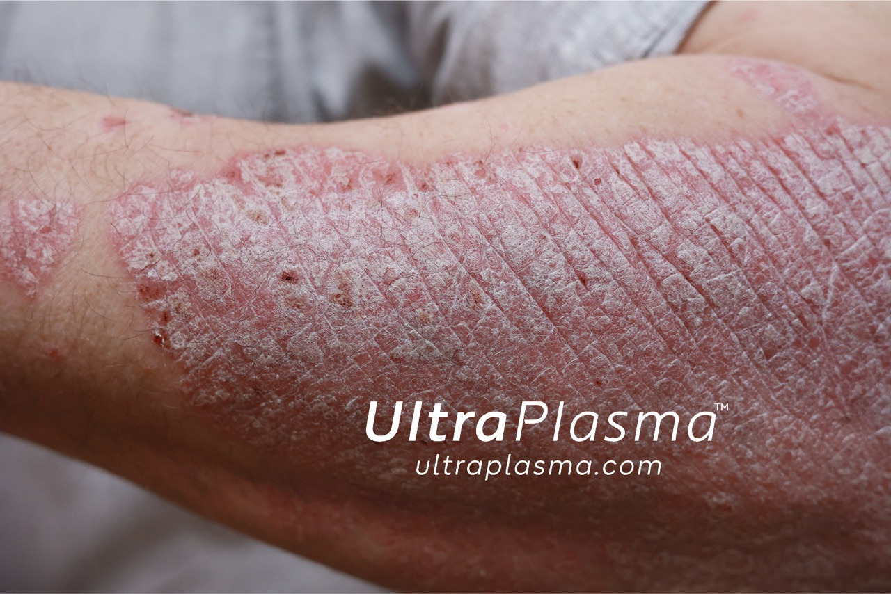 ultraplasma.com ultra plasma ultra plazma psoriasis sedef treatment tedavi