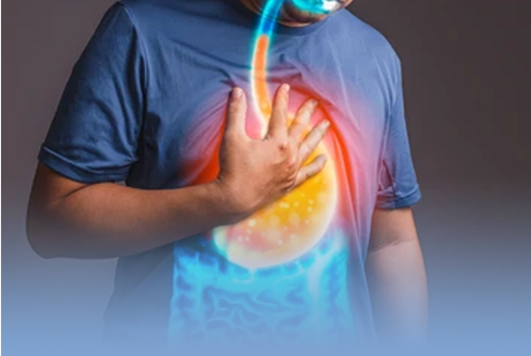 imagem que representa refluxo gastroesofágico
