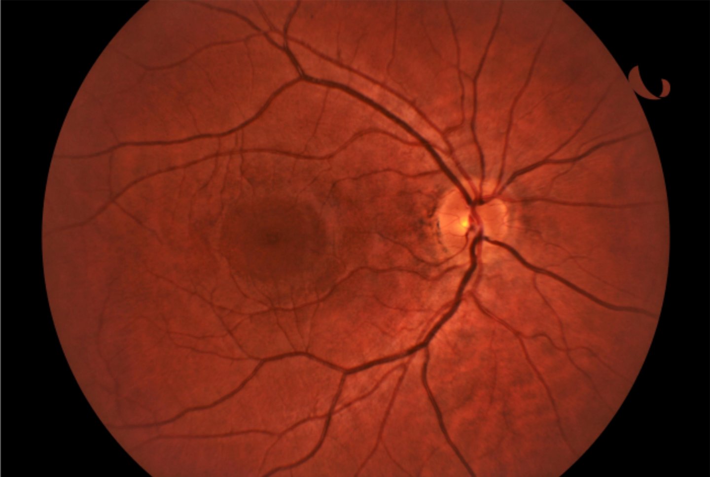 Retinal fundus photograph showing the optic nerve, macula, and blood vessels in a clinical eye exam.