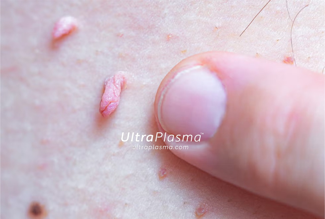 ultraplasma.com_skin_tag_removal_treatment_et_beni_temizleme_silme_tedavi_ultra_plasma_ultra_plazma2