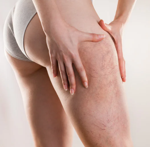 Varizes nas pernas: emoções paradas