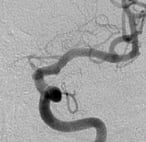 Angiografia após a cirurgia no cérebro e a clipagem do aneurisma cerebral.