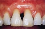 déchaussement dents hygiene-precision.com