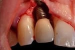 péri-implantite infection implant dentaire hygiene-precision.com