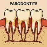 Parodontie la parodontite hygiene-precision.com