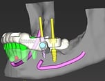 CBCT virtual planning