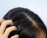 Dandruff