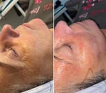 Dermaplane and Microdermabrasion