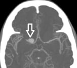 Angiotomografia corte axial mostrando o aneurisma cerebral (seta).
