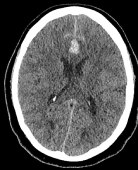 Tomografia computadorizada de crânio revelando hematoma intracerebral.
