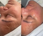 Microdermabrasion