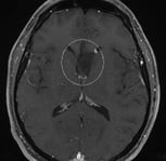 Ressonância de um paciente epiléptico com tumor fronto-basal antes da cirurgia no cérebro.