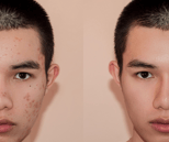 Acne treatment