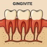 Parodontie la gingivite hygiene-precision.com