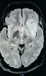 Intrinsic brain tumour in speech area. 