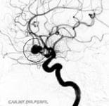 Angiografia projeção perfil mostrando o aneurisma cerebral.