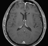 Ressonância após a cirurgia com a remoção total do tumor e paciente livre de epilepsia.