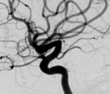 Angiografia digital projeção perfil após a cirurgia no cérebro e clipagem do aneurisma cerebral.