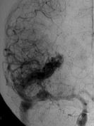 Angiografia carotídea projeção frontal mostrando a MAV.