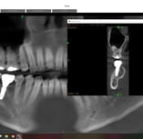 CBCT Scan 