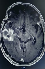 Tumour in left dominant temporal brain.