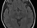 Ressonância após a cirurgia com remoção total do tumor.