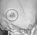 Tomografia 3D mostrando o tumor ósseo.