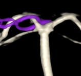 Angiografia digital 3D projeção frontal após a cirurgia no cérebro e clipagem do aneurisma cerebral.