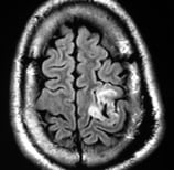 Ressonância de paciente epiléptico com tumor na área motora antes da cirurgia. no cérebro.