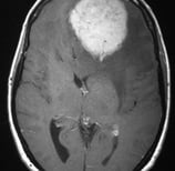 Ressonância de paciente com cefaleia e volumoso tumor frontal esquerdo antes da cirurgia no cérebro.