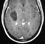 Ressonância de paciente epiléptica com tumor na ínsula direita antes da cirurgia no cérebro.