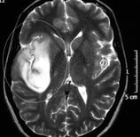 Ressonância de paciente epiléptica com tumor na ínsula direita antes da cirurgia no cérebro.
