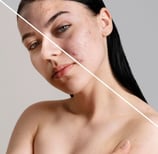 portrait-photo-retouching-blemish-and-scar-removal