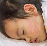 Kulit kemerahan pada anak