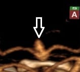 Angiotomografia projeção frontal. A seta indica o aneurisma cerebral.