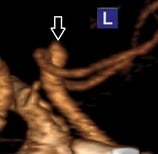 Angiotomografia 3D projeção perfil