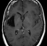 Ressonância após a cirurgia com remoção total do tumor.