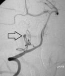 Angiografia digital projeção oblíqua. A seta indica o aneurisma cerebral.