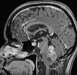 Ressonância de paciente com cefaleia e vômitos com volumoso tumor no cerebelo antes da cirurgia.
