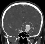 Angiotomografia projeção frontal demonstrando a presença de um volumoso aneurisma cerebral.