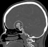 Angiotomografia projeção perfil. O círculo indica o volumoso aneurisma cerebral.